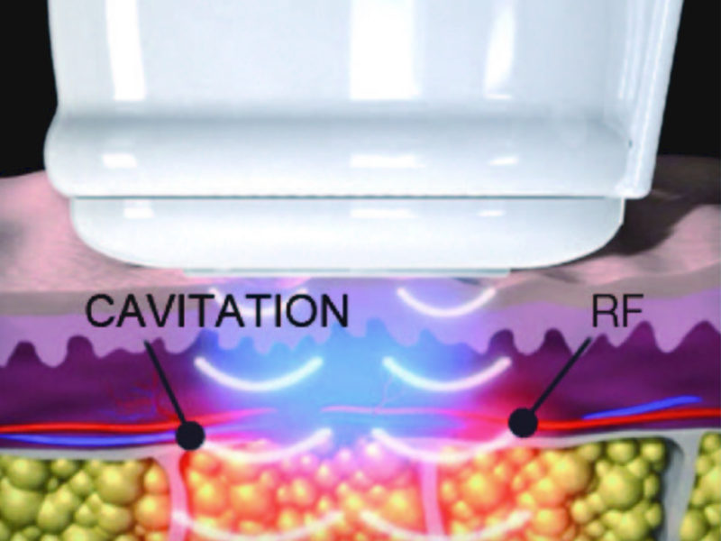 Cavitazione medica, con radiofrequenza