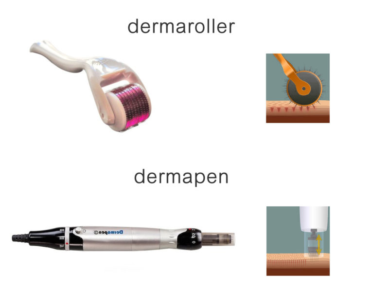 Tecnica needling distende le rughe e compatta la pelle