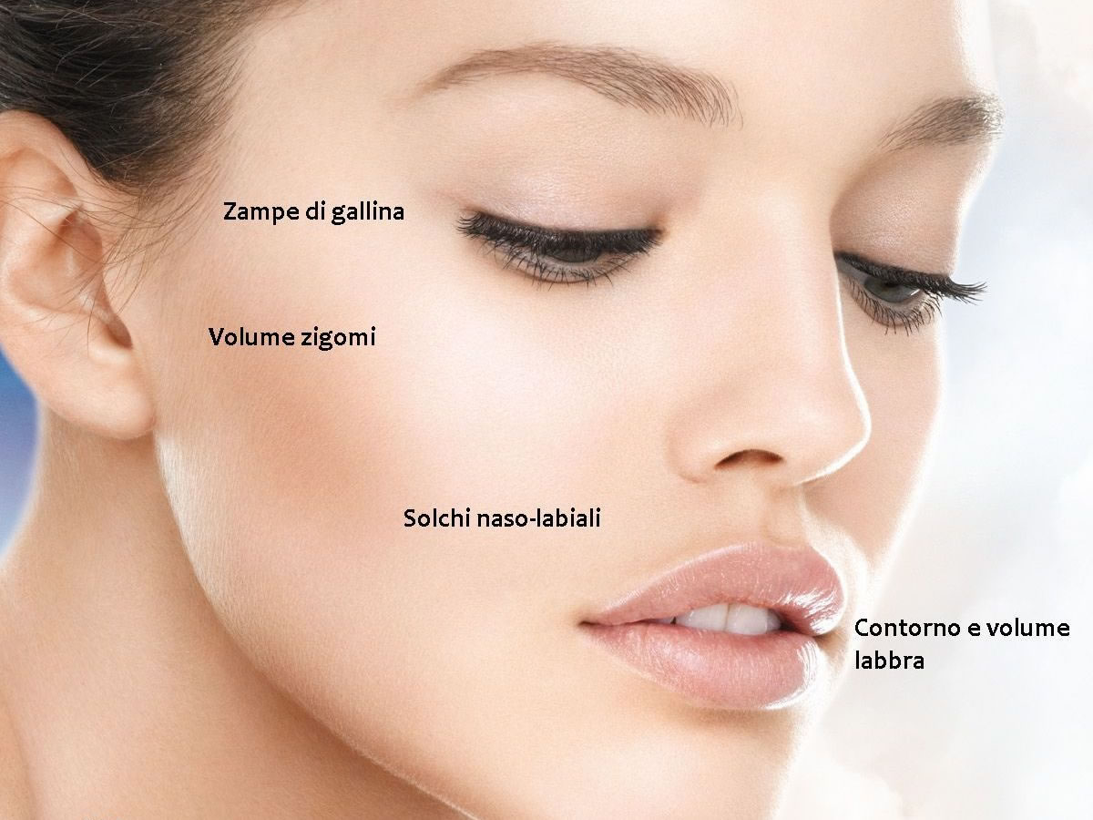 filler viso acido ialuronico