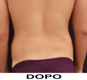 Foto dopo il trattamento di Criolipolisi