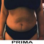 Foto prima del trattamento di Criolipolisi