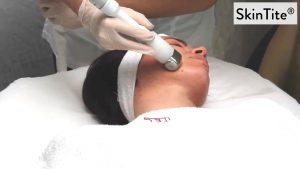 Radiofrequenza, microneedling e vacuum insieme per contrastare rughe e rilassamento cutaneo.