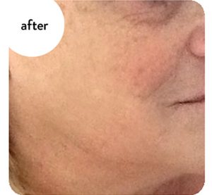 3 Tecnologie in 1 con Microneedling, Vacuum e Radiofrequenza frazionata per il ringiovanimento del viso.