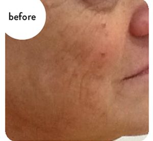 3 Tecnologie in 1 con Microneedling, Vacuum e Radiofrequenza frazionata per il ringiovanimento del viso.
