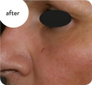 SkinTite, 3 Tecnologie in 1 con Microneedling, Vacuum e Radiofrequenza frazionata.