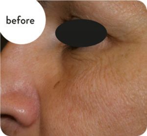 SkinTite, 3 Tecnologie in 1 con Microneedling, Vacuum e Radiofrequenza frazionata.