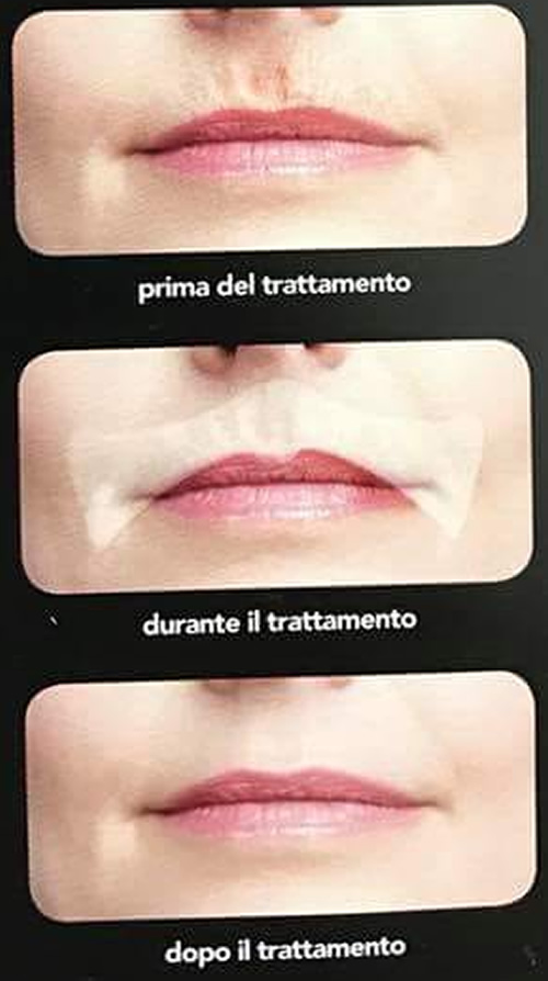 B-Selfie Smooth, il filler per il codice a barre, le foto prima e dopo