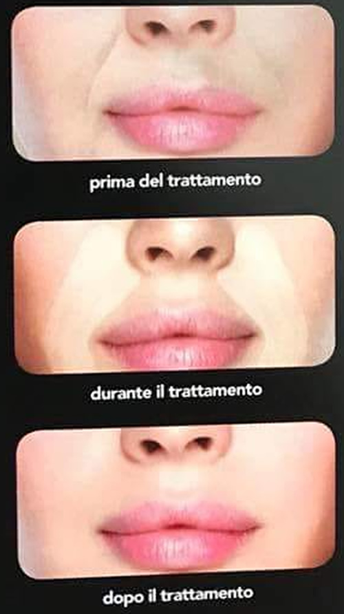 B-Selfie Ageless, il filler per i solchi naso genieni, le foto prima e dopo