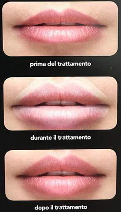 B-Selfie volume, il filler per le labbra, le foto prima e dopo