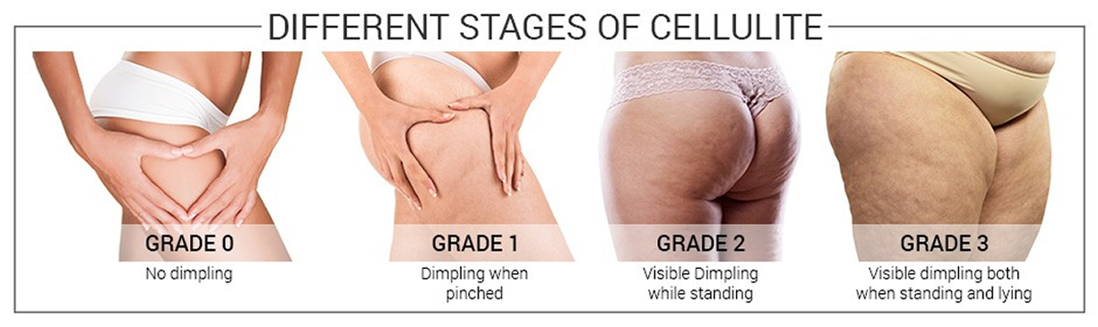 cellulite esterno coscia