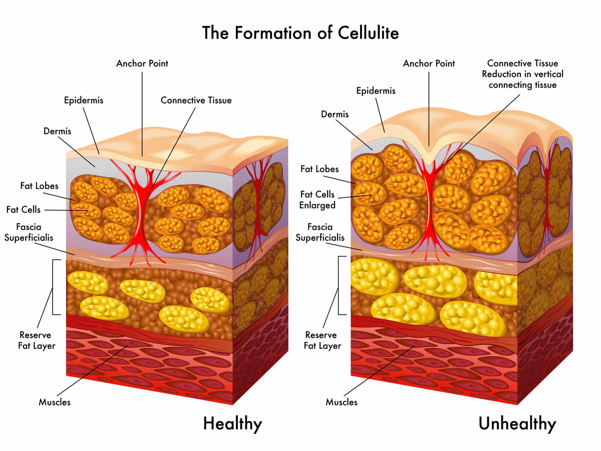Come è fatta la cellulite