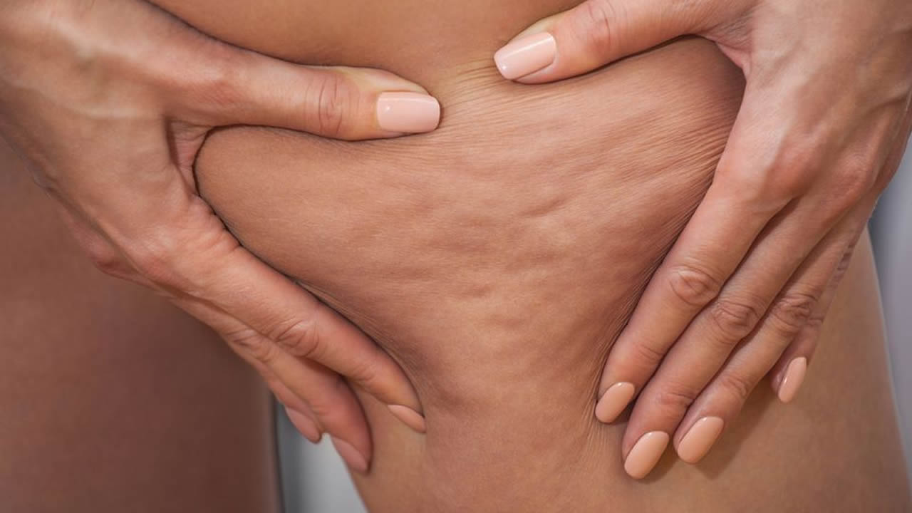 Coscia con cellulite