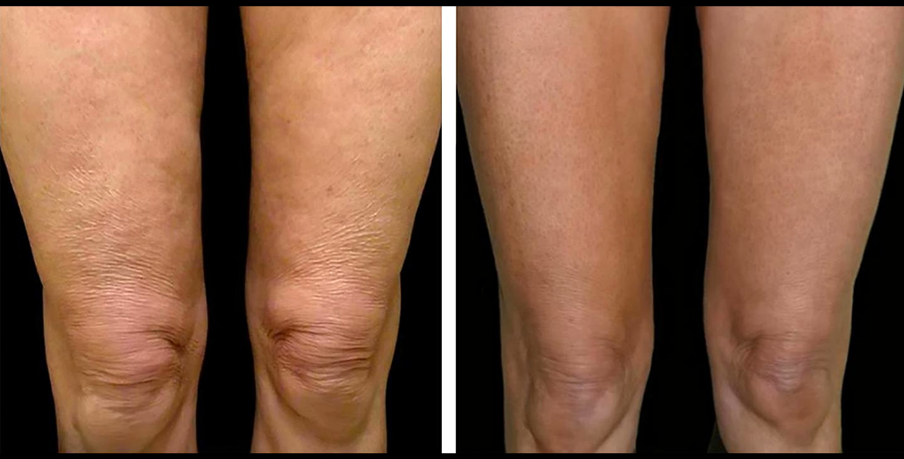 cellulite sulle braccia