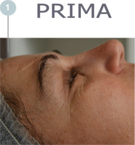 TMC 3+ Action –prima- Prima del trattamento TMC 3+ Action