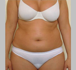 Addome donna prima Esempio addome donna prima