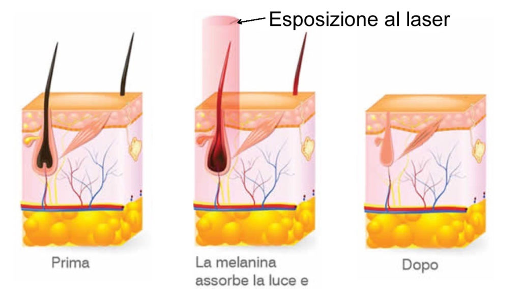 Esposizione del pelo al laser