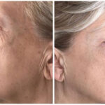 Resurfacing viso, collo e décolleté