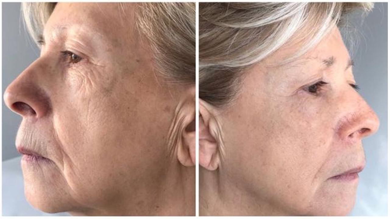 Mosaic HP, Resurfacing viso, collo e décolleté Resurfacing viso, collo e décolleté