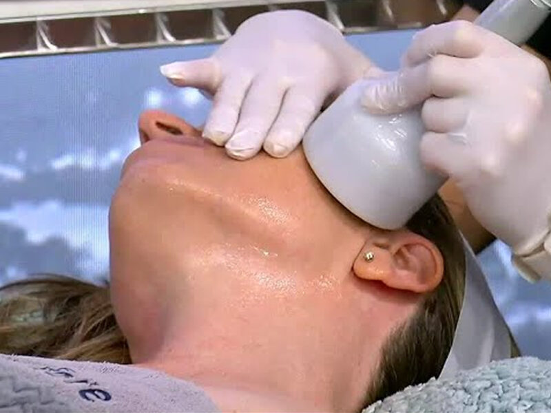 CryoLift, le basse temperature per ringiovanire il viso