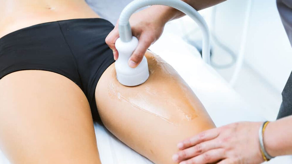 CryoCellulite la criolipolisi per eliminare la cellulite