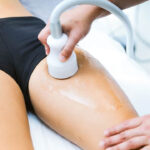 CryoCellulite la criolipolisi per eliminare la cellulite