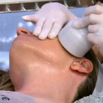 CryoLift per ringiovanire e rassodare la pelle del viso e del collo