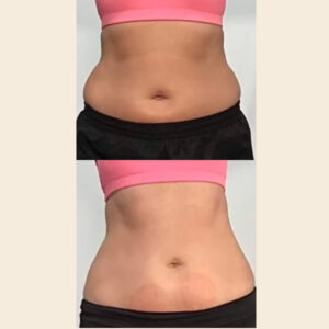 CryoSlim addome