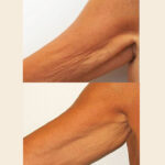 CryoTone braccia CryoTone braccia