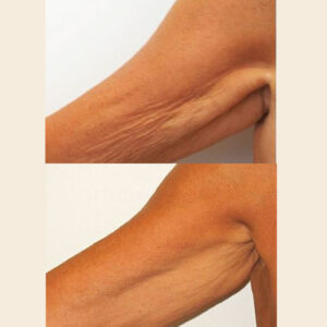 CryoTone braccia