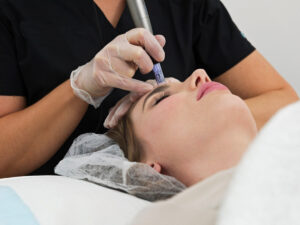Dermapen needling e attivi