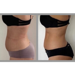 Criolipolisi addome prima