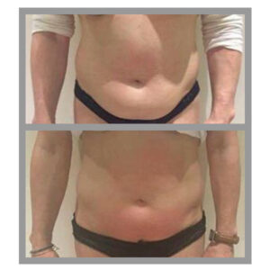 Criolipolisi addome fianchi