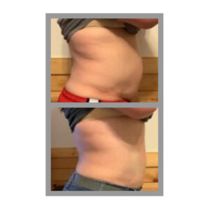 Criolipolisi addome 2